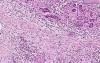 Adenocarcinoma - Histopathology of pancreas