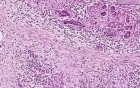Adenocarcinoma - Histopathology of pancreas