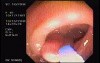 Tubulo - Villous Adenoma - Endoscopy (14 of 28)
