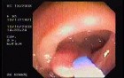Tubulo - Villous Adenoma - Endoscopy (14 of 28)