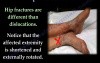 Hip Dislocations and Treatment - Video Lecture
