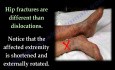 Hip Dislocations and Treatment - Video Lecture