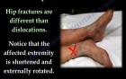 Hip Dislocations and Treatment - Video Lecture