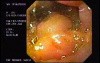 Duodenal B Cell Lymphoma (4 of 7)