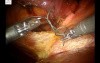 Robotic Morgagni Hernia