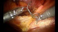 Robotic Morgagni Hernia