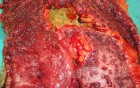 Multiple Rectal Ulcers (93 of 110)