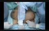 Mastopexy without Scars