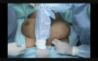 Mastopexy without Scars