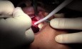 Sites, Flap Design & Reflection - Maxillary Bone Grafting #7-8-10