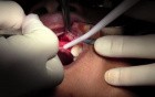 Sites, Flap Design & Reflection - Maxillary Bone Grafting #7-8-10