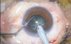 Phacoemulsification - Chopper Usage 