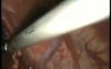 Conversion of Nissen Fundoplication to Cardiomyotomy & Toupet - Laparoscopy
