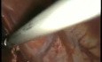 Conversion of Nissen Fundoplication to Cardiomyotomy & Toupet - Laparoscopy