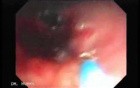 Endoscopic Resection of Giant Tubulo-Villous of the rectum (34 of 35)
