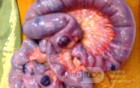 Blue Rubber Bleb Naevus Syndrome