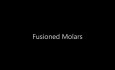 Maxillary Fusioned Molars