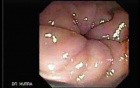 Cap polyposis that resemble a adenocarcinoma of the rectum (7 of 7)