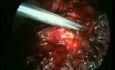 Laparocopic Hysterectomy