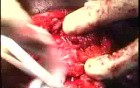 Parotidectomy