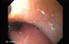 Uvula with Herpes
