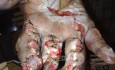 Crush Injury Of Left Hand After Surgical Intervention