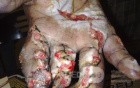 Crush Injury Of Left Hand After Surgical Intervention