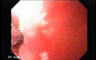 Squamous cell carcinoma of the larynx 73-year-old smoker (2 of 4)