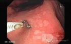 Gastric Cancer - Intestinal Metaplasia - Endoscopy (7 of 7)