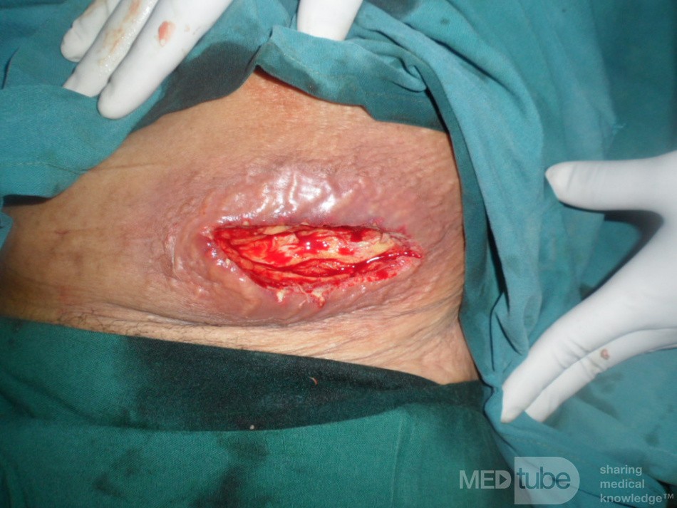 Carbuncle - Anterior Abdominal Wall 2