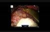 Robotic Right Adrenalectomy