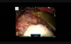 Robotic Right Adrenalectomy