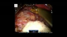 Robotic Right Adrenalectomy