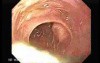 Adenocarcinoma of the Cardias - Closer Look at the Papilla of Vater, Part 1