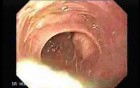 Adenocarcinoma of the Cardias - Closer Look at the Papilla of Vater, Part 1