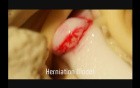 Herniation Model