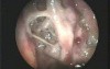 Maggots In Atrophic Rhinits Nose