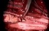 Spinal tumor Surgery