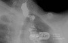 Colonic interposition for Esophageal Substitution (12 of 14)