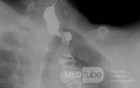 Colonic interposition for Esophageal Substitution (12 of 14)