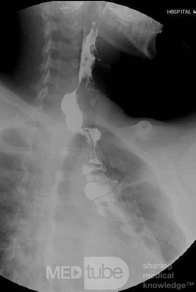 Colonic interposition for Esophageal Substitution (12 of 14)