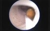 ADAM simulator- kidney stone removal
