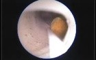 ADAM simulator- kidney stone removal