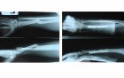 Galiazzi fracture dislocation