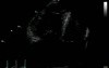 Acute Pulmonary Heart Disease - Thrombus Pulmonary Artery