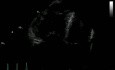 Acute Pulmonary Heart Disease - Thrombus Pulmonary Artery