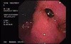 Zollinger- Ellison Syndrome - Gastric Ulcer with Gastrocolic Fistula (7 of 21)