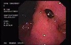 Zollinger- Ellison Syndrome - Gastric Ulcer with Gastrocolic Fistula (7 of 21)
