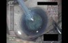 Cataract Surgery 2 - Part 2