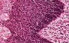 Erythroplasia of Queyrat - Histopathology of penis